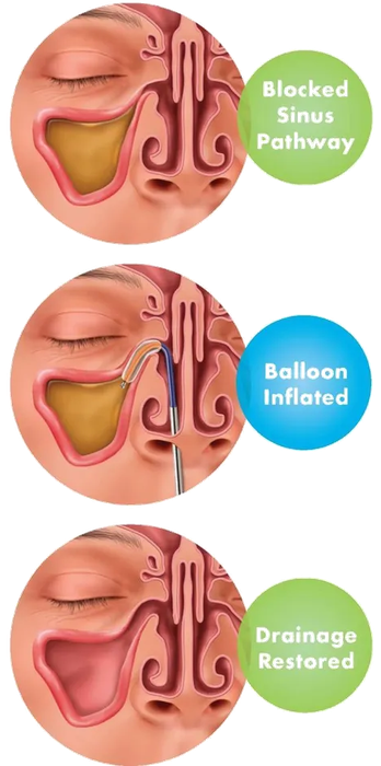 Balloon sinuplasty procedure steps: blocked sinus pathway, balloon inflated, drainage restored