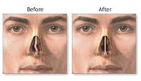 Before and after nasal obstruction surgery, showing improved nasal airway alignment