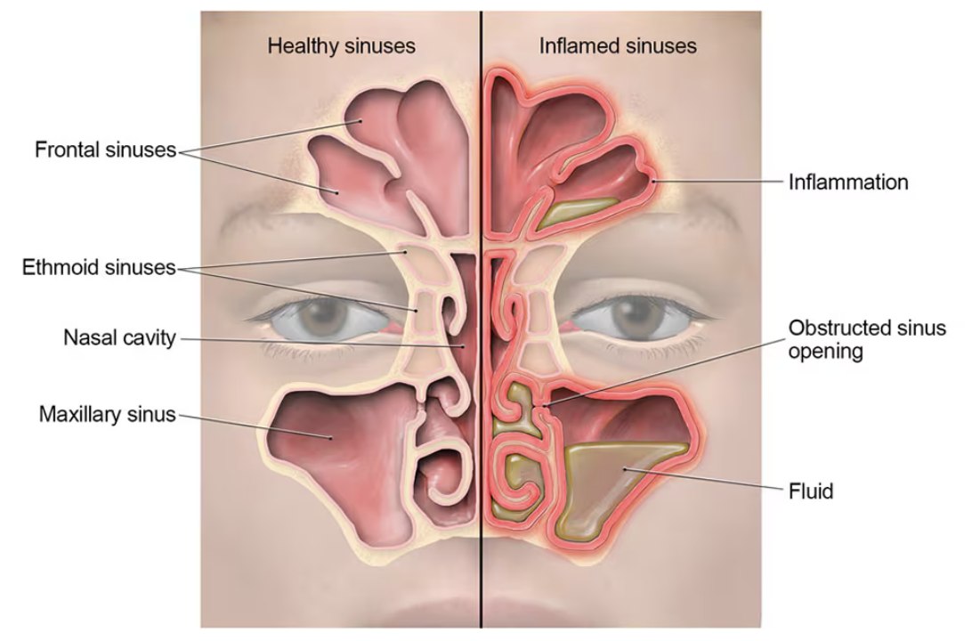 Comparison of healthy vs. inflamed sinuses. Anatomical diagram showing the frontal, ethmoid, and maxillary sinuses in a normal state (left) versus sinusitis (right), with visible inflammation, obstructed sinus openings, and fluid buildup.